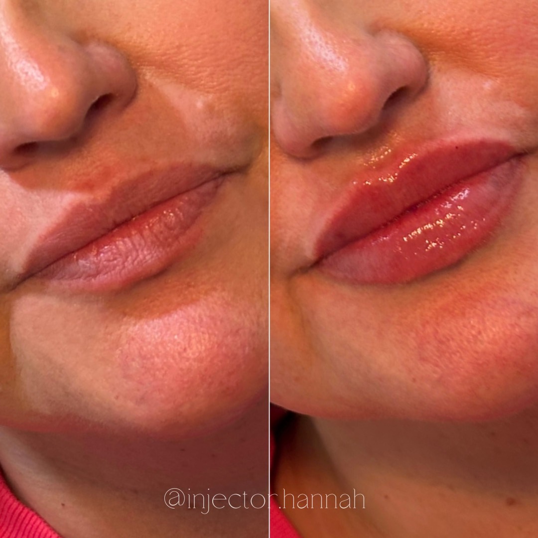 Forehead lines before/after – smoother after 2 weeks
